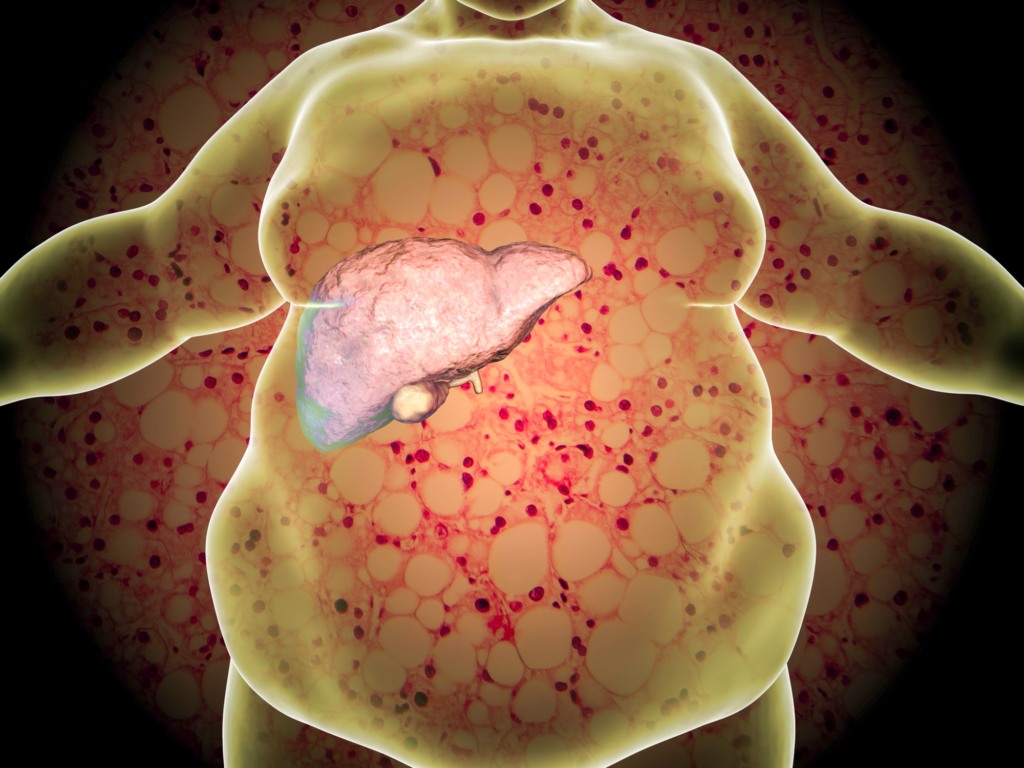 Fructose Association With Non Alcoholic Fatt liver